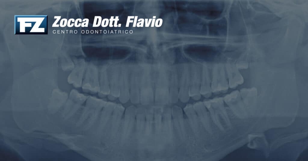 Radiografie dentali: sono davvero pericolose? Tutto quello che devi sapere 1 Radiografie dentali: sono davvero pericolose? Tutto quello che devi sapere