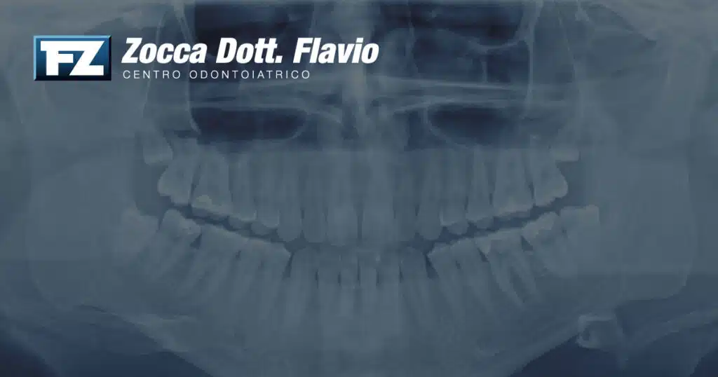 Radiografie dentali: sono davvero pericolose? Tutto quello che devi sapere