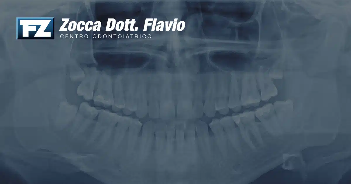 Radiografie dentali: sono davvero pericolose? Tutto quello che devi sapere