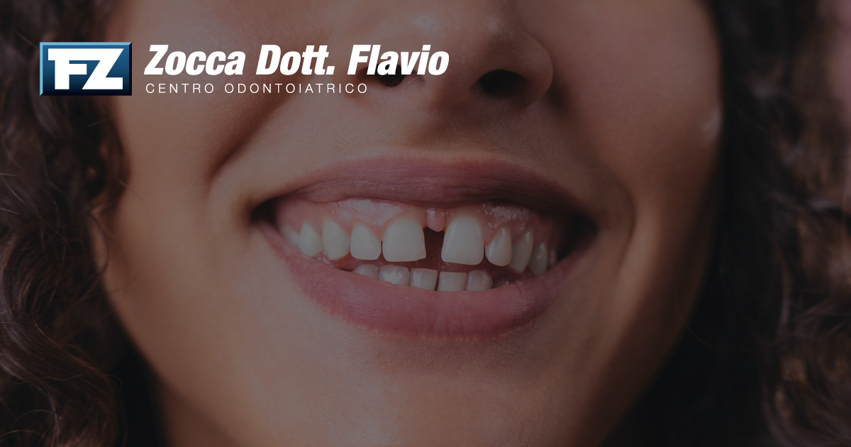 Rimedi per il diastema: come chiudere lo spazio tra i denti